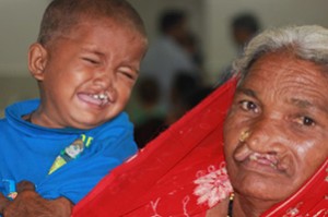 Child and grandma with cleft lip deformity