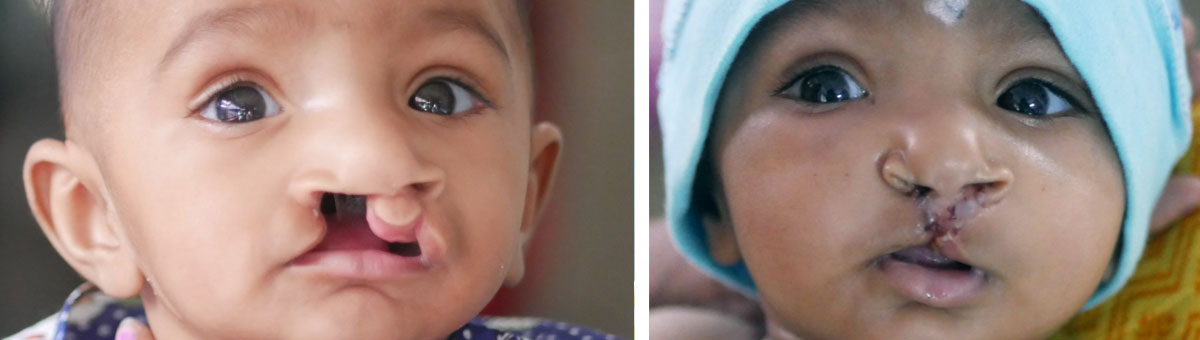 Runali Bagde before and after surgery